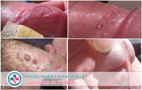 
						Thuốc trị sùi mào gà nhanh chóng và hiệu quả