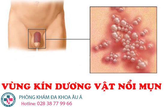 
						Khám Và Điều Trị Sớm Nổi Mụn Ở Vùng Kín, Dương Vật Nam Giới Với Combo Chỉ 200k